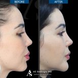 Before and after chin implant results at Dr. Safa Manav Clinic, improved chin profile