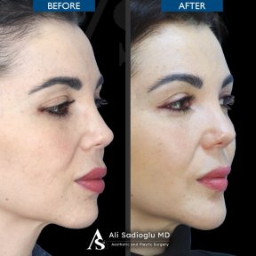 Before and after chin implant results at Dr. Safa Manav Clinic, enhanced chin profile