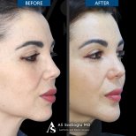 Before and after chin implant results at Dr. Safa Manav Clinic, enhanced chin profile