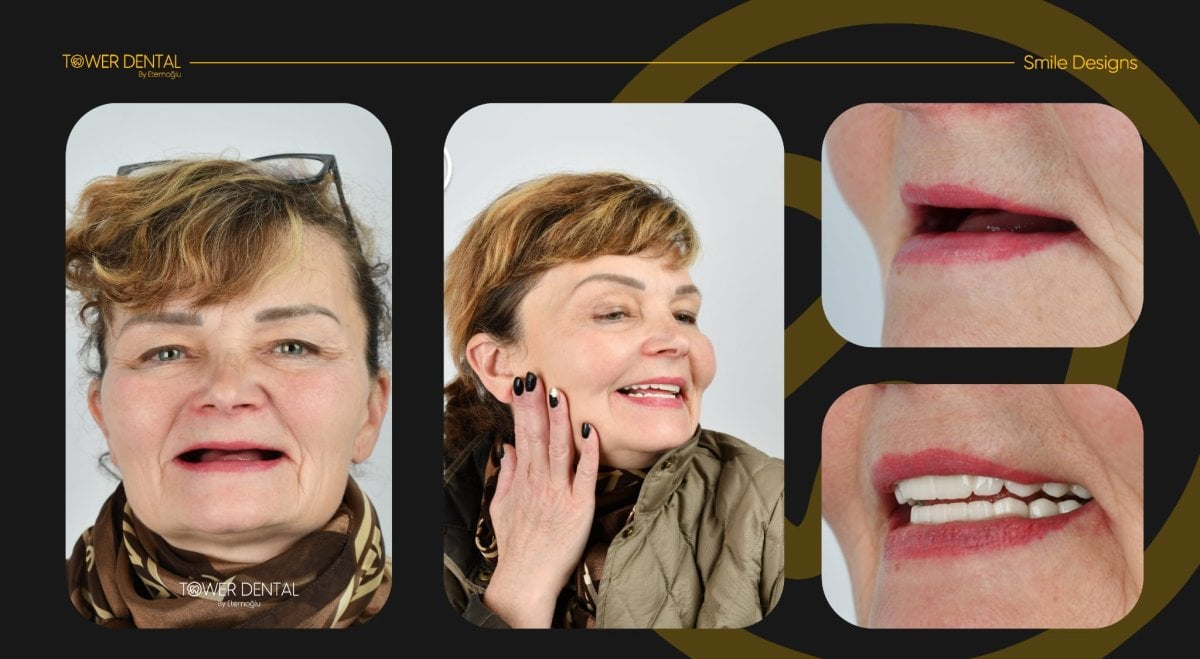 Resultados antes y después de implantes All-on-6 en Tower Dental Clinic, restauración de sonrisa