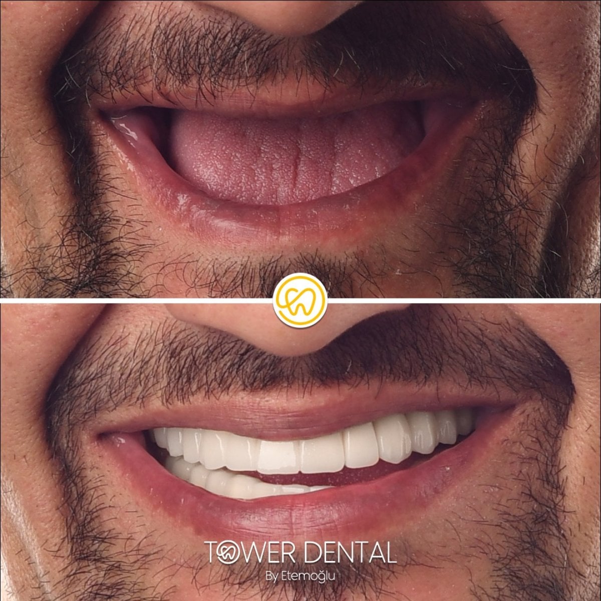 Resultado antes y después de implantes All-on-6 en Tower Dental Clinic, sonrisa restaurada