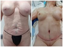 Before and after tummy tuck results at Hospital de la Familia, improved abdominal contour