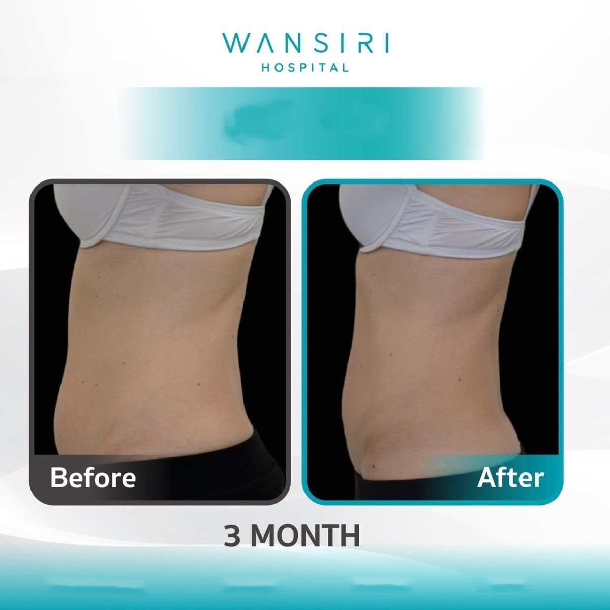 Resultados de criolipólisis antes y después en Wansiri Hospital, reducción de grasa en 3 meses
