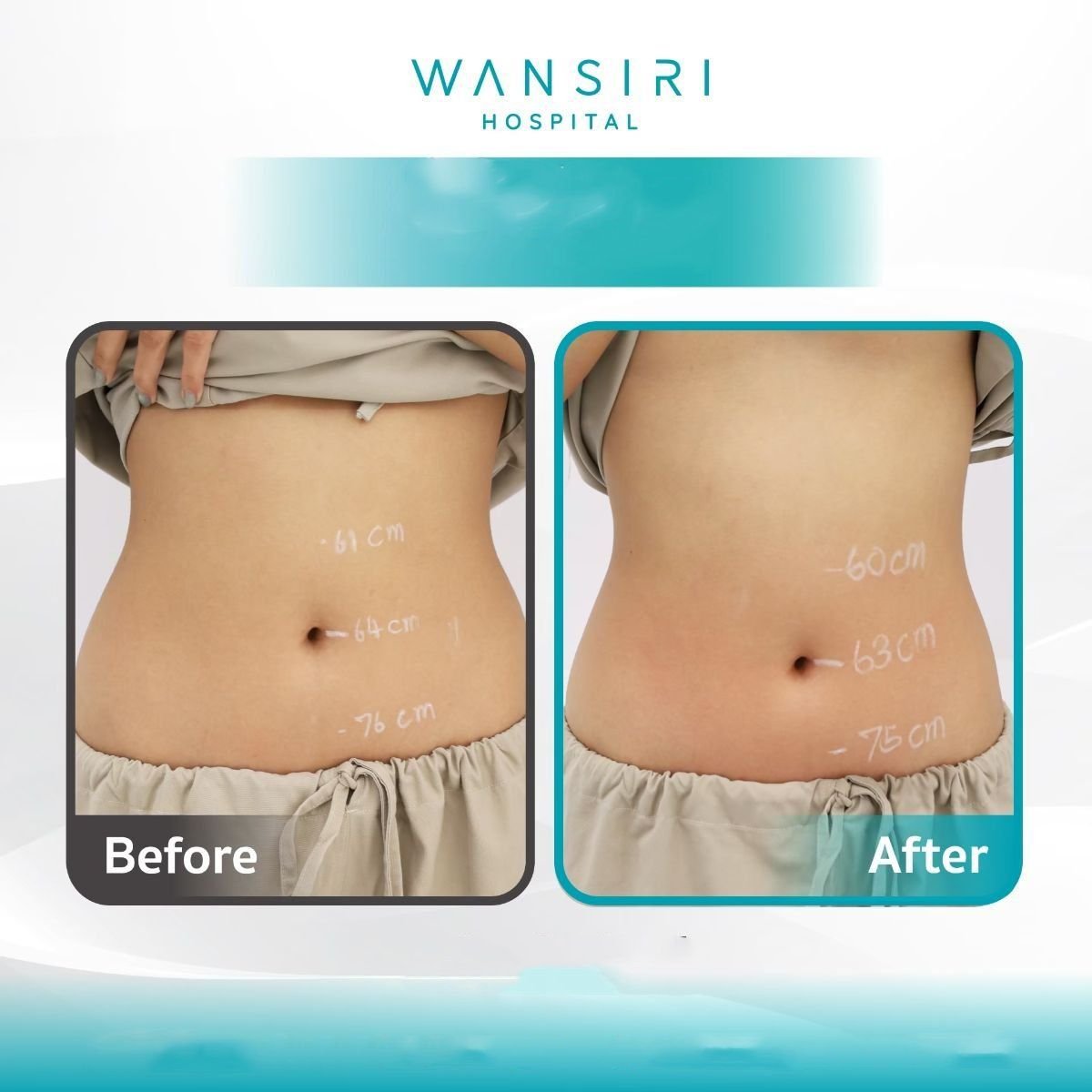 Resultados antes y después de criolipólisis en Wansiri Hospital, reducción visible de grasa abdominal