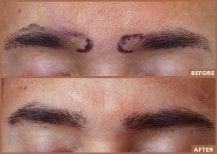 Before and after eyebrow transplantation results at Wansiri Hospital, fuller natural brows