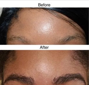 Before and after eyebrow transplantation results at Wansiri Hospital, fuller brows achieved