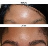 Before and after eyebrow transplantation results at Wansiri Hospital, fuller brows achieved