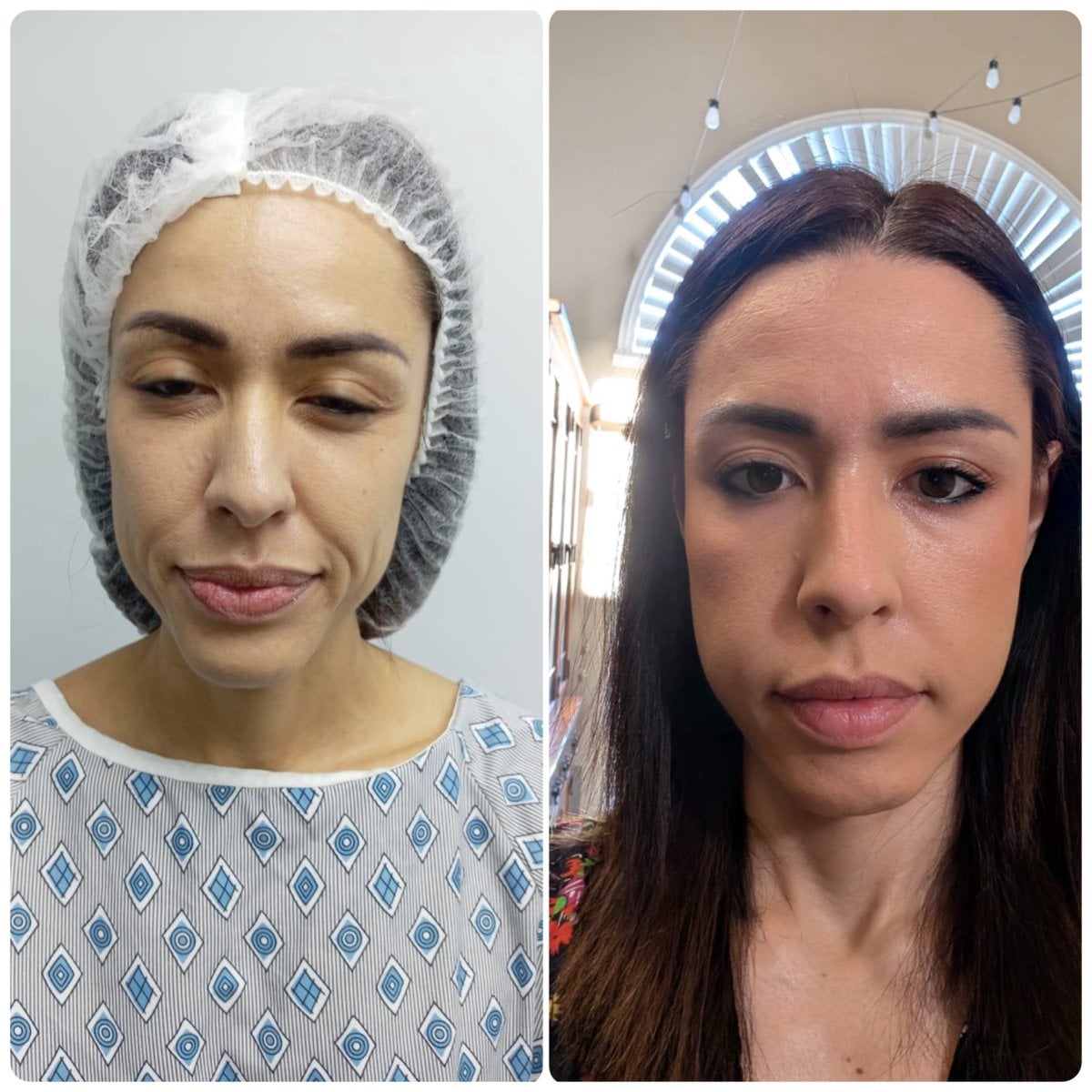 Before and after mini facelift results at Hospital de la Familia, facial rejuvenation procedure