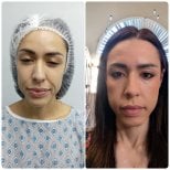 Before and after mini facelift results at Hospital de la Familia, facial rejuvenation procedure