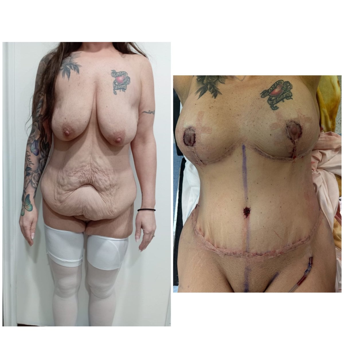 Mommy makeover results at Hospital de la Familia