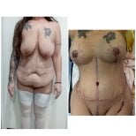 Before and after mommy makeover results at Hospital de la Familia, body contouring and lift