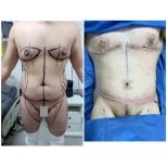 Before and after tummy tuck and liposuction results at Hospital de la Familia, male patient