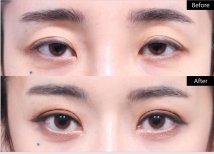 Before and after droopy eyelid surgery results at VG Plastic Surgery, improved eye appearance