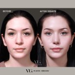 Результаты ринопластики до и после в VG Plastic Surgery, коррекция носа через 10 дней