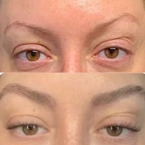 Before and after eyebrow transplantation results at Wansiri Hospital, fuller natural brows