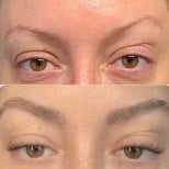 Before and after eyebrow transplantation results at Wansiri Hospital, fuller natural brows