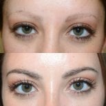 Before and after eyebrow transplantation results at Wansiri Hospital, fuller natural brows