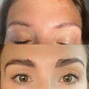 Before and after eyebrow transplantation results at Wansiri Hospital, fuller natural brows