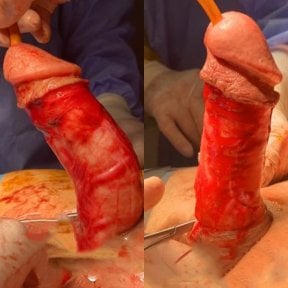Before and after penile curvature correction surgery results for Peyronie's disease at Uroaesthetic