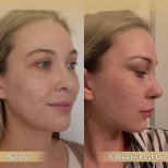 Vorher-nachher-Ergebnis Brauenlifting bei Dr. Safa Manav Clinic, sichtbare Anhebung