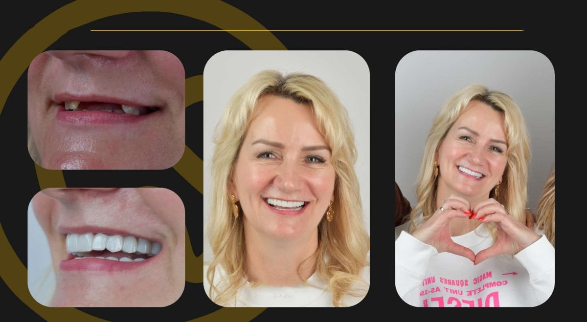 نتائج قبل وبعد زراعة الأسنان All-on-6 في Tower Dental Clinic، ابتسامة مستعادة