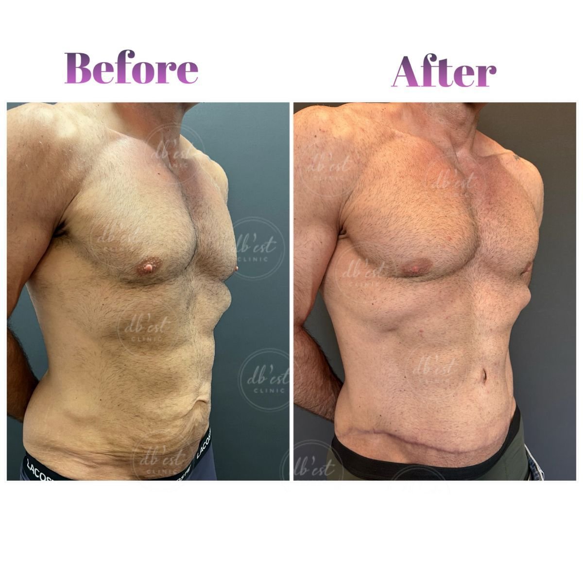 Resultados de abdominoplastia antes y después en Db'est Clinic, mejor contorno abdominal masculino