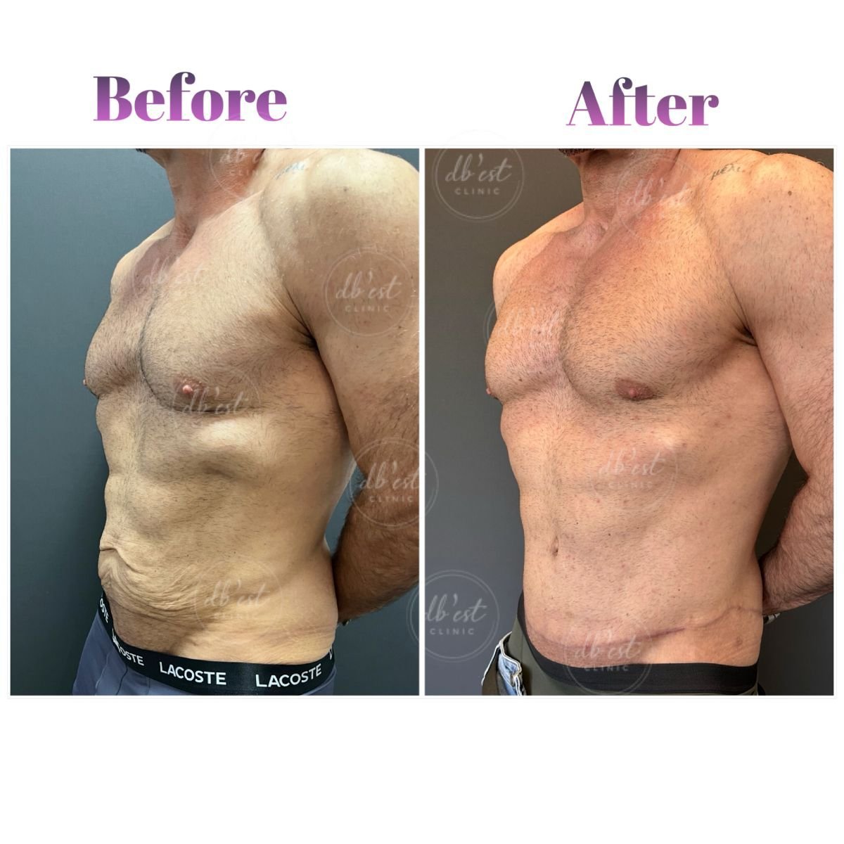 Resultados de abdominoplastia antes y después en Db'est Clinic, mejor contorno abdominal masculino