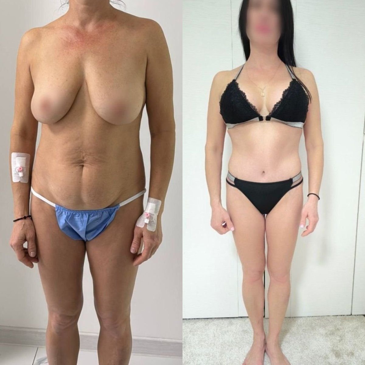 Résultats avant/après lifting mammaire à la Dmytrii Homola Clinic, silhouette améliorée