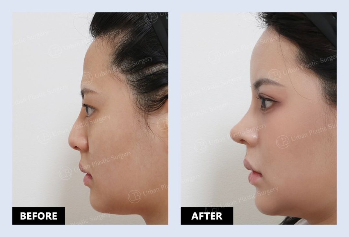 نتائج قبل وبعد عملية تصغير فتحات الأنف في URBAN Plastic Surgery، تحسين شكل الأنف