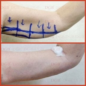 Resultados antes y después de lifting de brazos (braquioplastia) en DGB Clinic, mejor contorno