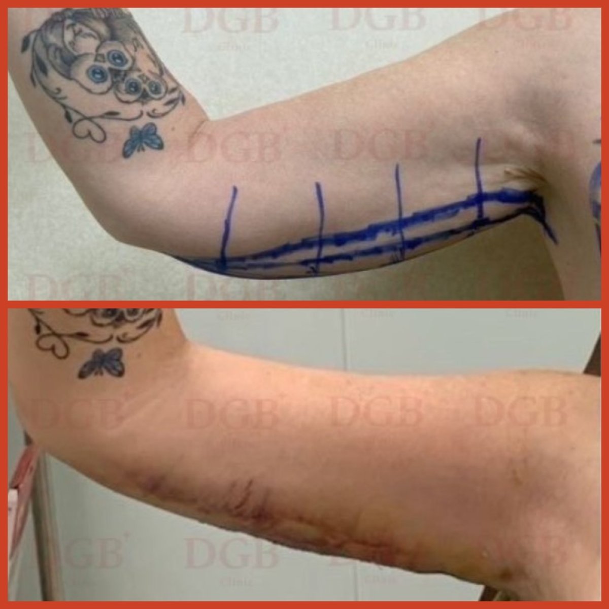 Résultats avant/après lifting des bras (brachioplastie) à DGB Clinic – contour amélioré