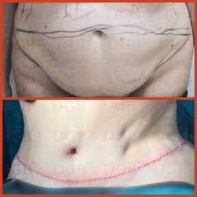 Результаты абдоминопластики до и после в DGB Clinic – улучшенный контур живота