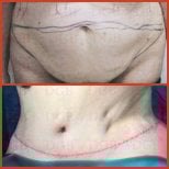 Результаты абдоминопластики до и после в DGB Clinic – улучшенный контур живота