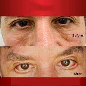 Before and after lower eyelid blepharoplasty results at DGB Clinic, reduced under-eye bags