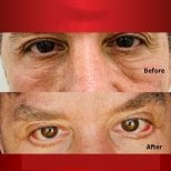 Before and after lower eyelid blepharoplasty results at DGB Clinic, reduced under-eye bags