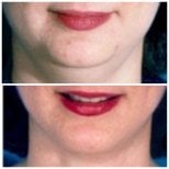 Before and after jaw shaping at ID Clinic Bangkok, improved chin contour and jawline result