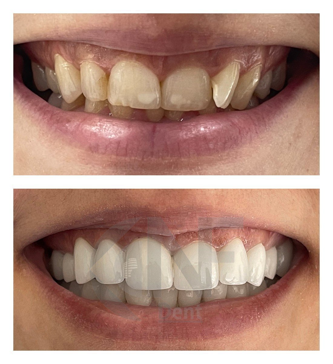 Resultados antes y después de reemplazo de coronas dentales en Nifa Dent International, sonrisa mejorada