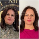 Vorher-nachher-Ergebnis endoskopisches Facelifting bei Dr. Safa Manav Clinic