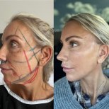 Vorher-nachher-Ergebnis Halsstraffung bei Dr. Safa Manav Clinic, definierte Kontur