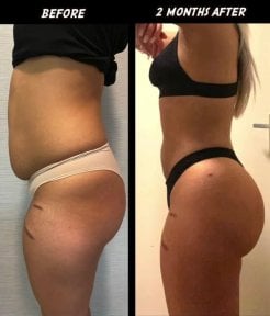 Vorher-nachher-Bauchdeckenstraffung bei Dr. Safa Manav Clinic, sichtbare Kontur