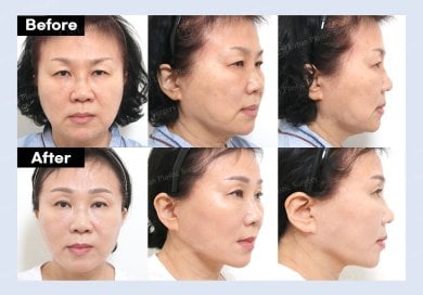 Результаты эндоскопической подтяжки лица до и после в URBAN Plastic Surgery, омоложение лица