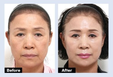 Результаты до и после эндоскопической подтяжки лица в URBAN Plastic Surgery, омоложение лица