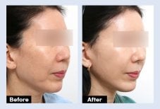 Результаты эндоскопической подтяжки лица до и после в URBAN Plastic Surgery, омоложение