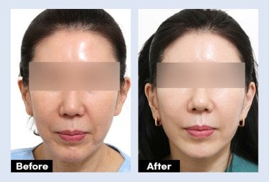 Результаты до и после эндоскопической подтяжки лица в URBAN Plastic Surgery