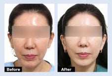 Результаты до и после эндоскопической подтяжки лица в URBAN Plastic Surgery