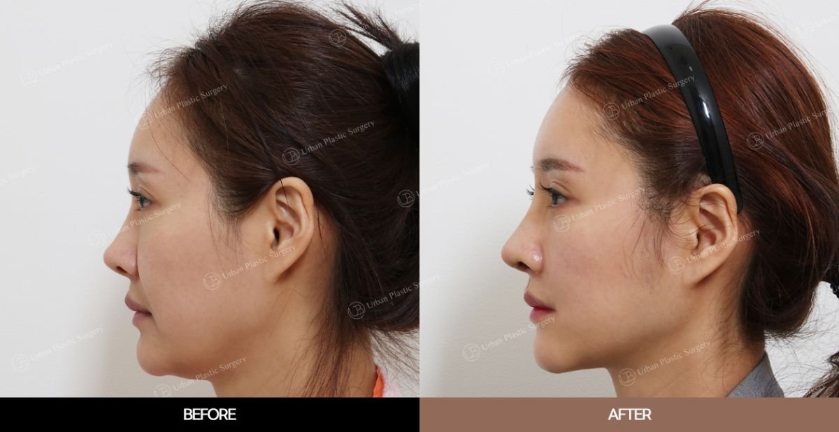 Resultados de lifting endoscópico facial antes y después en URBAN Plastic Surgery, mejora del contorno