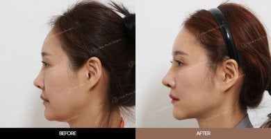 Результаты эндоскопической подтяжки лица до и после в URBAN Plastic Surgery, улучшение контура