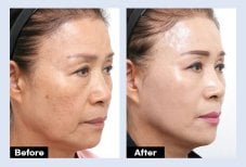 Результаты до и после эндоскопической подтяжки лица в URBAN Plastic Surgery