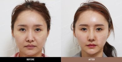 Результаты эндоскопической подтяжки лица до и после в URBAN Plastic Surgery, омоложение