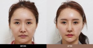 Результаты эндоскопической подтяжки лица до и после в URBAN Plastic Surgery, омоложение